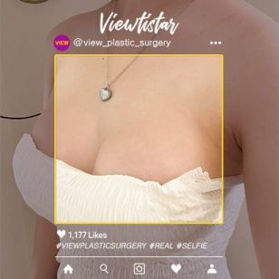 [Breast Augmentation (Motiva)] An Hyeongyeong
