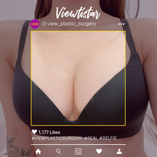 [Breast Augmentation(Motiva)] Kim Rin a