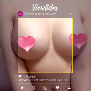[Breast Augmentation(Motiva)] Kim Sia