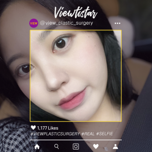 [Double Eyelid Surgery revision] Jo heejoo