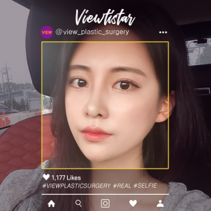 [Double Eyelid Surgery + Rhinoplasty + Fat Graft + Face Liposuction] Kim Jieun