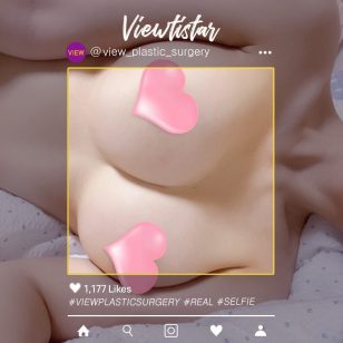 [Breast Augmentation (Motiva)] Oh Yumi