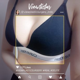 [Breast Augmentation (Motiva)] Yoon Hyejin