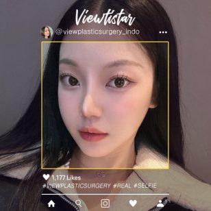 [Kontur Wajah 3 Jenis + Operasi revisi hidung] Song Gayoung | Plastic Surgery Korea