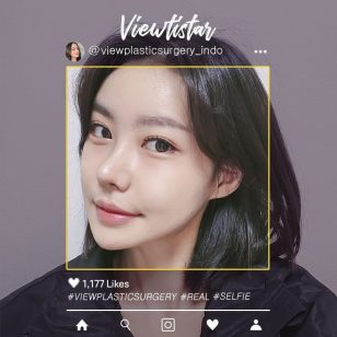 [Kontur Wajah 2 Jenis + Implan smile line + Operasi revisi hidung] Lee Yuna | Plastic Surgery korea