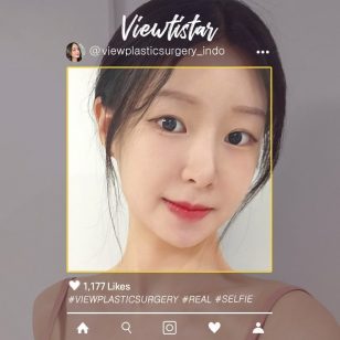[Kontur Wajah 3 Jenis + Operasi Hidung + Isi lemak(pelipis, Dahi, Pelipis)] Park Sooyeon | Plastic Surgery Korea