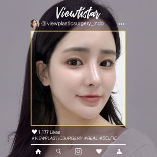 [Kontur Wajah 3 Jenis + Operasi Hidung + Isi lemak(Dahi, Pelipis, Pipi)] Maeng Jihye | Plastic Surgery Korea