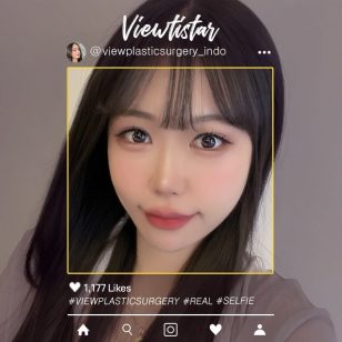 [Operasi Revisi Mata + Sudut Mata Dalam] So yuna | Plastic Surgery Korea