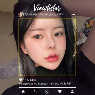 [Operasi Mata+Operasi Hidung+Isi lemak+Sedot lemak wajah] Kang Yooseon | Plastic Surgery Korea