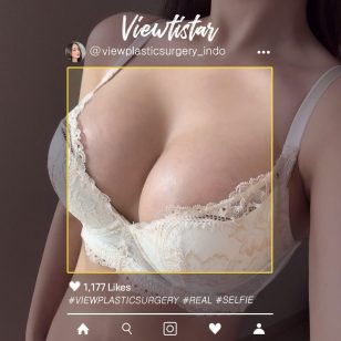 [Operasi Payudara (Motiva)] Lee Yumi | Plastic Surgery Korea