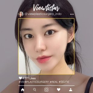 [Reposisi Lemak Bawah Mata, Isi lemak(Double chin, pipi, garis rahang)] Joe Yeseul | Plastic Surgery Korea