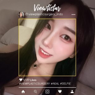 [Operasi Sudut Mata (Sudut Mata Dalam, Sudut Mata Belakang, Sudut Mata Bawah)] Seo seryeong | Plastic Surgery Korea