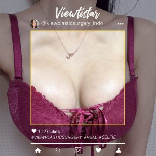 [Operasi Payudara(Sebbin)] Lee Hyeri | Plastic Surgery Korea