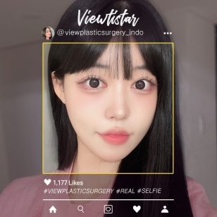 [Operasi Mata+Tarik Benang+Sedot lemak wajah+Isi lemak] Park Sehee | Plastic Surgery Korea