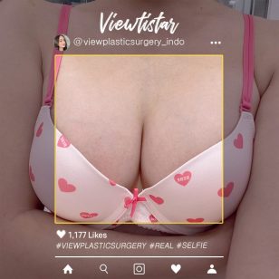 [Operasi Payudara (Mentor boost)] Jeon Soyeon | Plastic Surgery Korea